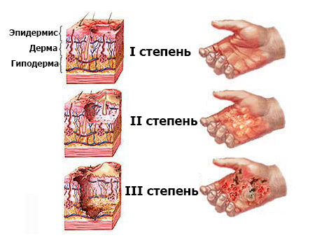 Международная классификация степени ожога