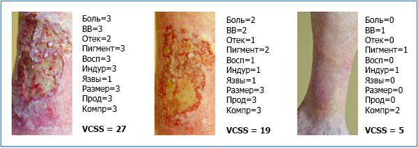 Клиническая шкала оценки тяжести венозных заболеваний (VCSS)